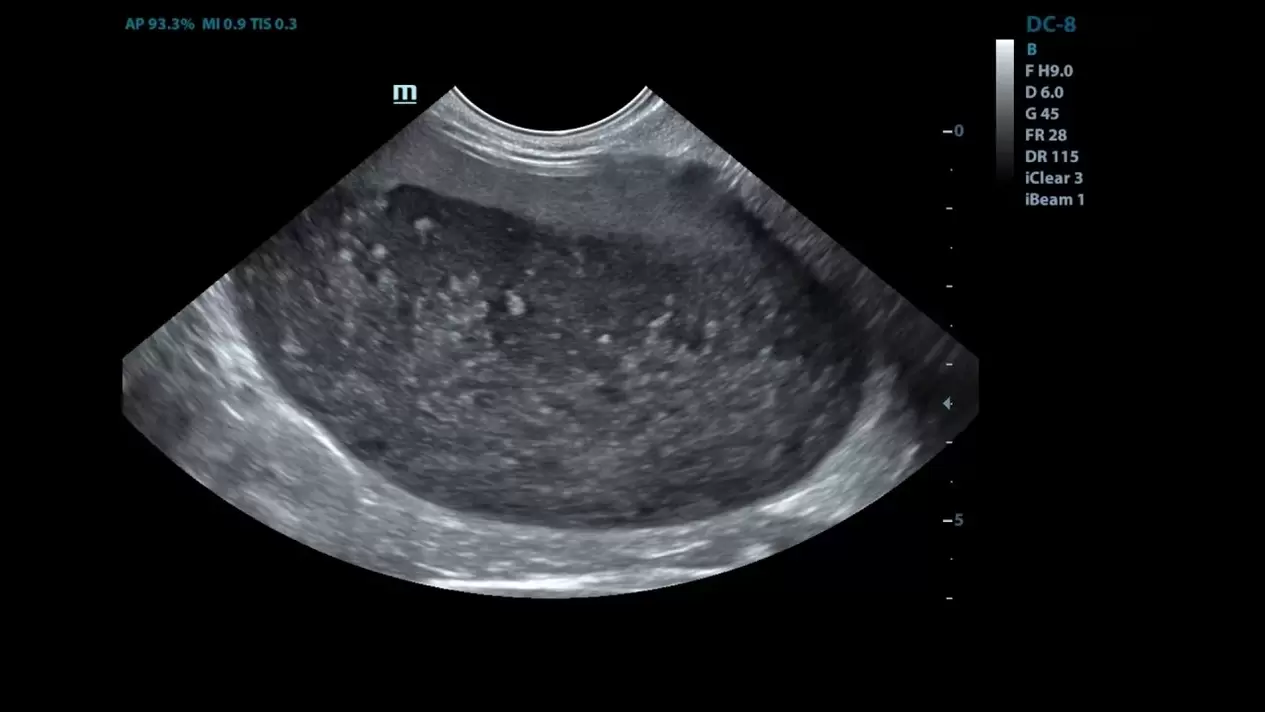 Cystite dans mes images échographiques avant d'utiliser Cystolax