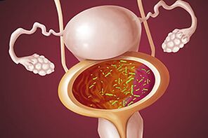 Cystite bactérienne chez une femme