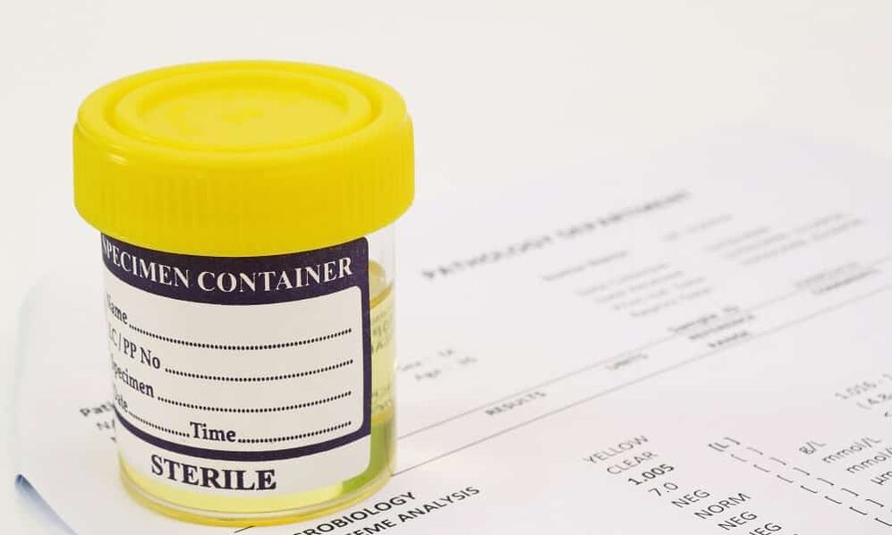 Un test d'urine doit être fait avant de prendre des antibiotiques